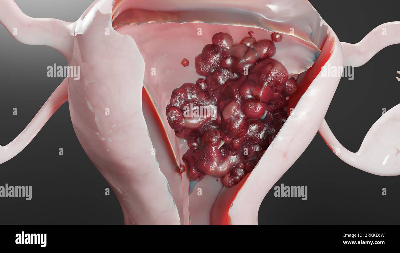 Tumore maligno dell'utero, anatomia femminile dell'utero, sistema riproduttivo, cellule tumorali, cisti ovariche, cancro cervicale, cellule in crescita, malattia ginecologica Foto Stock