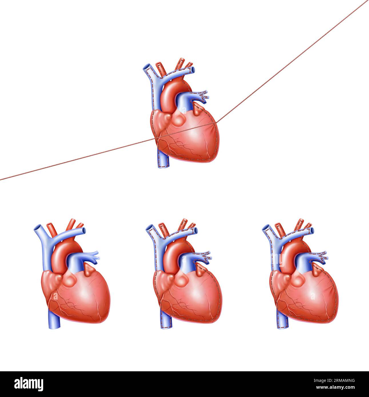 trattamento cardiaco Foto Stock