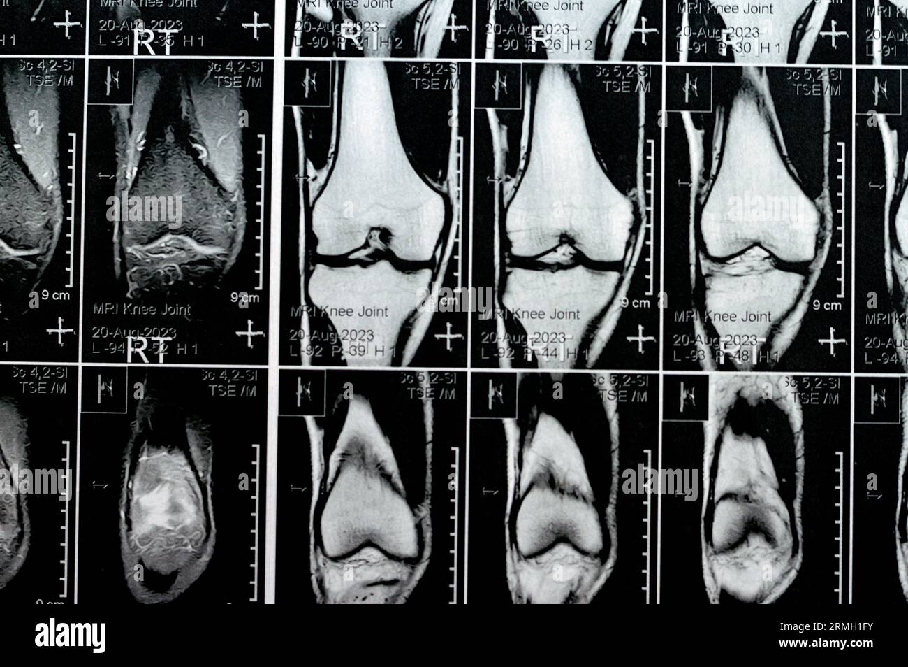 Risonanza magnetica del ginocchio destro con lieve versamento articolare, con altri risultati normali di PHMM, ACL, MCL, LCL, LM, legamenti, rotula, tendini, nervi, muscoli Foto Stock