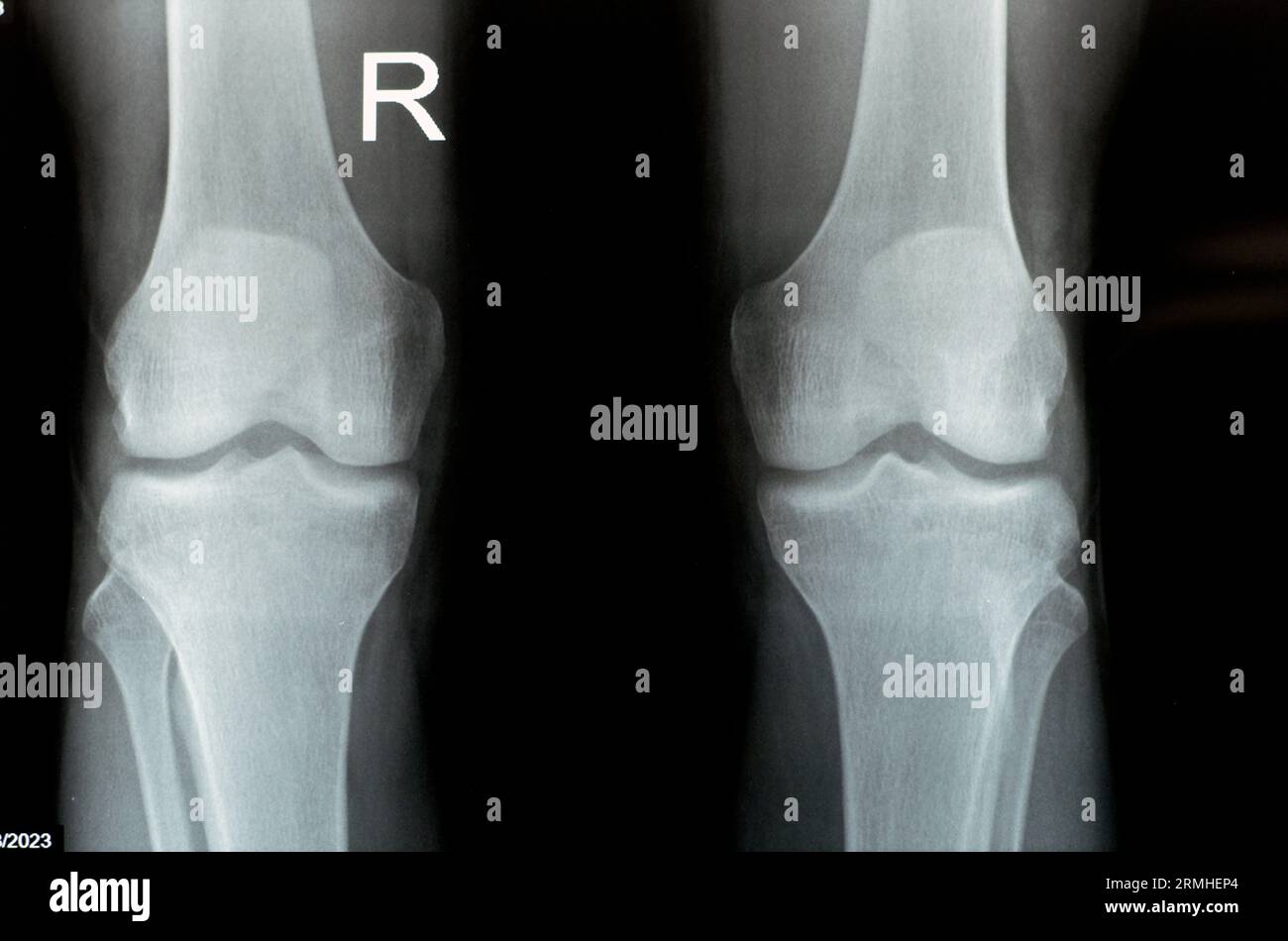 Radiografia semplice delle articolazioni del ginocchio destro e sinistro con la parte inferiore del femore e le parti superiori della tibia, della perone e della rotula che mostrano una normale Unione del ginocchio di A. Foto Stock