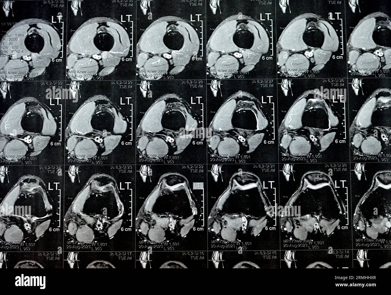 RM dell'articolazione del ginocchio sinistro con versamento articolare minimo, tromba posteriore PHMM degenerazione menisco mediale, legamento crociato anteriore ACL lieve distorsione, n Foto Stock