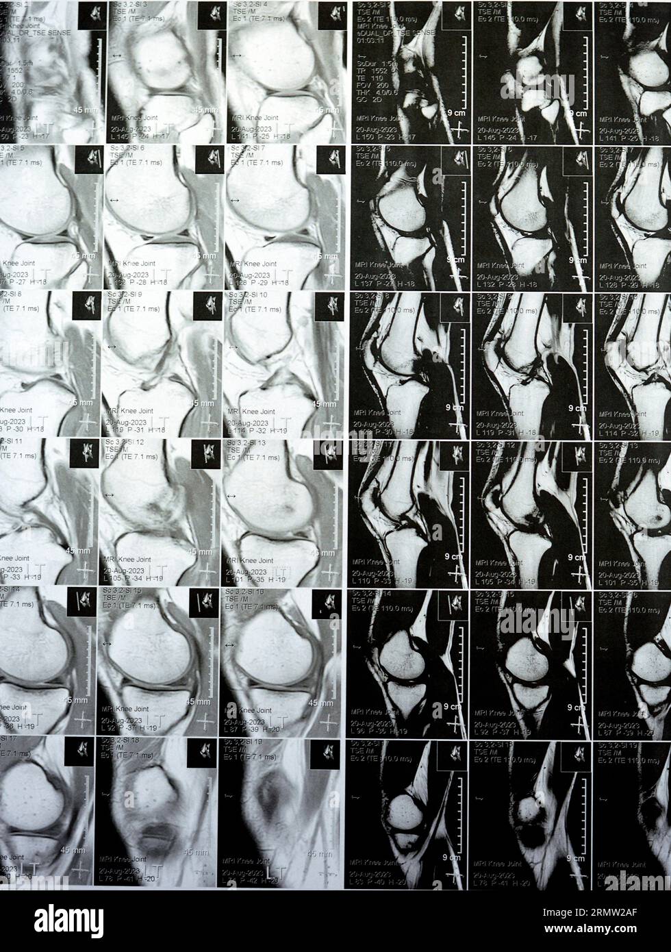 RM dell'articolazione del ginocchio sinistro con versamento articolare minimo, tromba posteriore PHMM degenerazione menisco mediale, legamento crociato anteriore ACL lieve distorsione, n Foto Stock