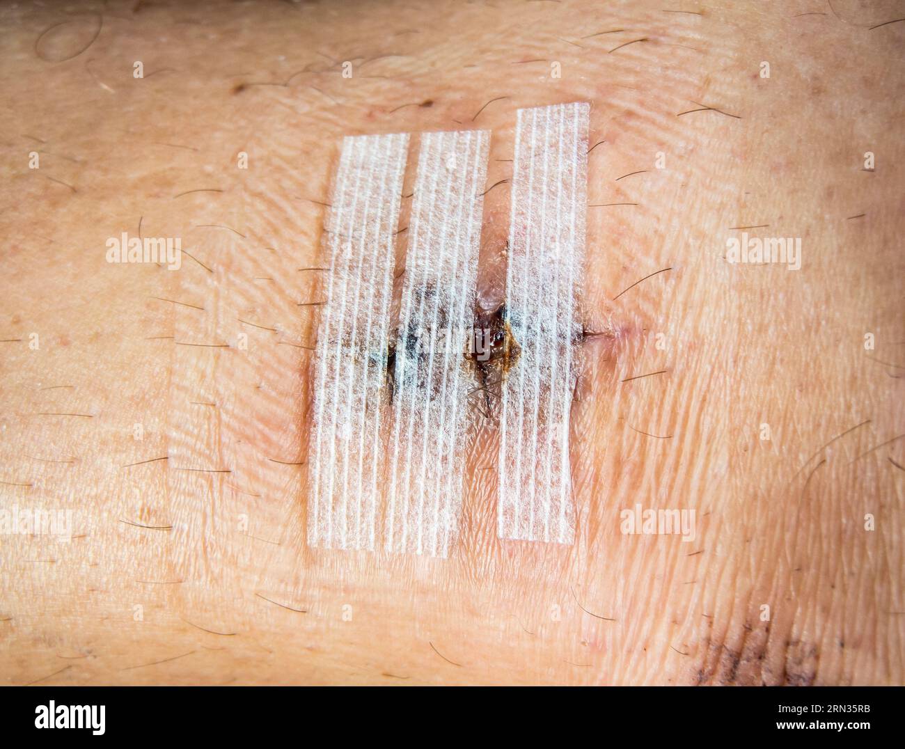 Primo piano di una cicatrice sulla parte inferiore della gamba tenuta insieme all'intonaco dopo la rimozione dei punti. Foto Stock