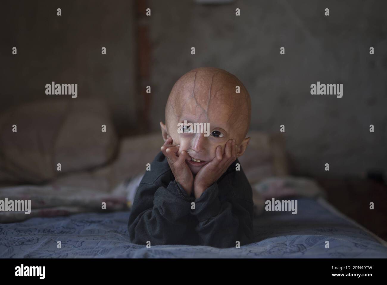 (150514) -- MORENO, 14 maggio 2015 -- Franco Villavicencio, di quattro anni, guarda i cartoni animati televisivi a casa nella città di Moreno, in provincia di Buenos Aires, Argentina, il 13 maggio 2015. Franco soffre di progeria (o invecchiamento prematuro). I bambini con questa malattia sembrano sani alla nascita, ma durante il primo anno di vita iniziano a mostrare le caratteristiche della patologia come crescita più bassa, perdita di capelli, invecchiamento della pelle, ecc. Martin Zabala) (zjy) ARGENTINA-MORENO-HEALTH-PROGERIA e MARTINxZABALA PUBLICATIONxNOTxINxCHN 150514 Moreno maggio 14 2015 Franco Villavicencio quattro anni Vecchio Orologi TV cartoni animati A casa in il Foto Stock