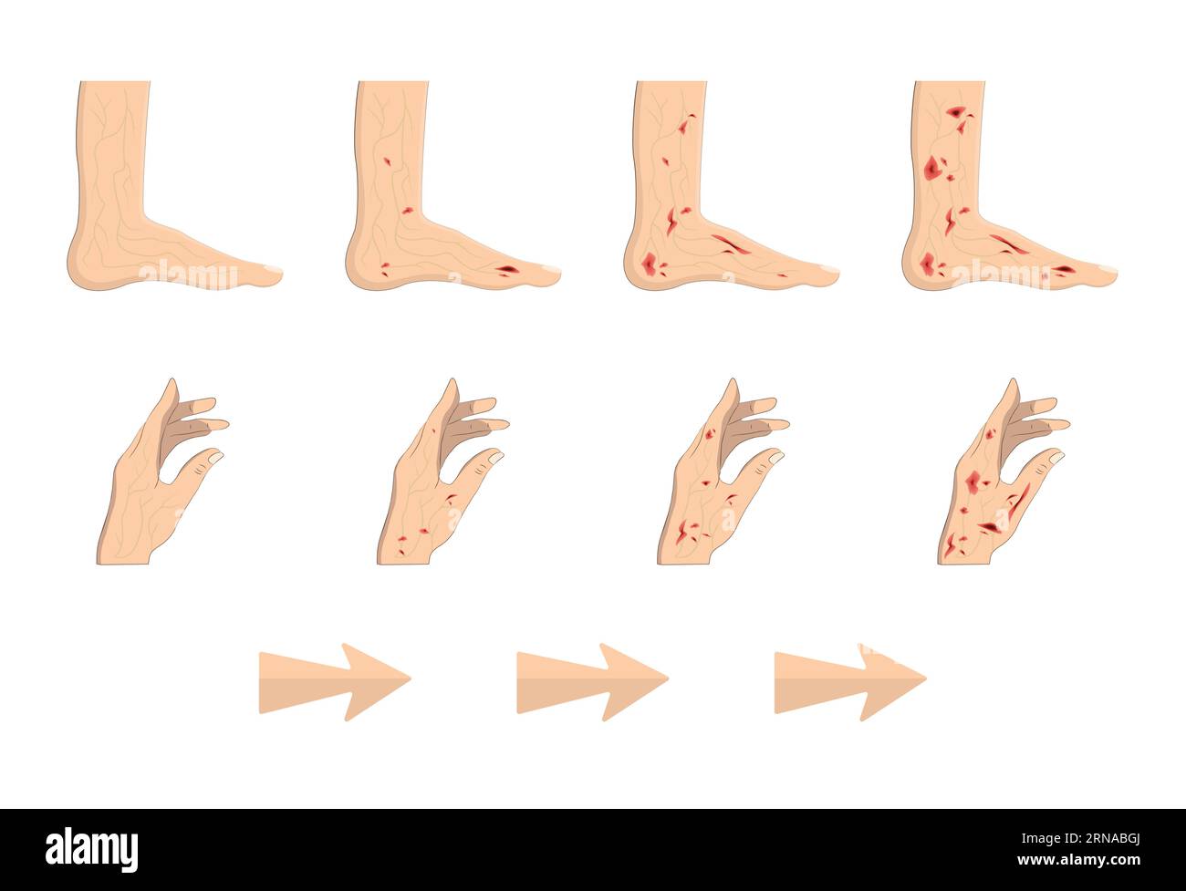 Diabetico, illustrazione vettore piedi di zucchero Illustrazione Vettoriale