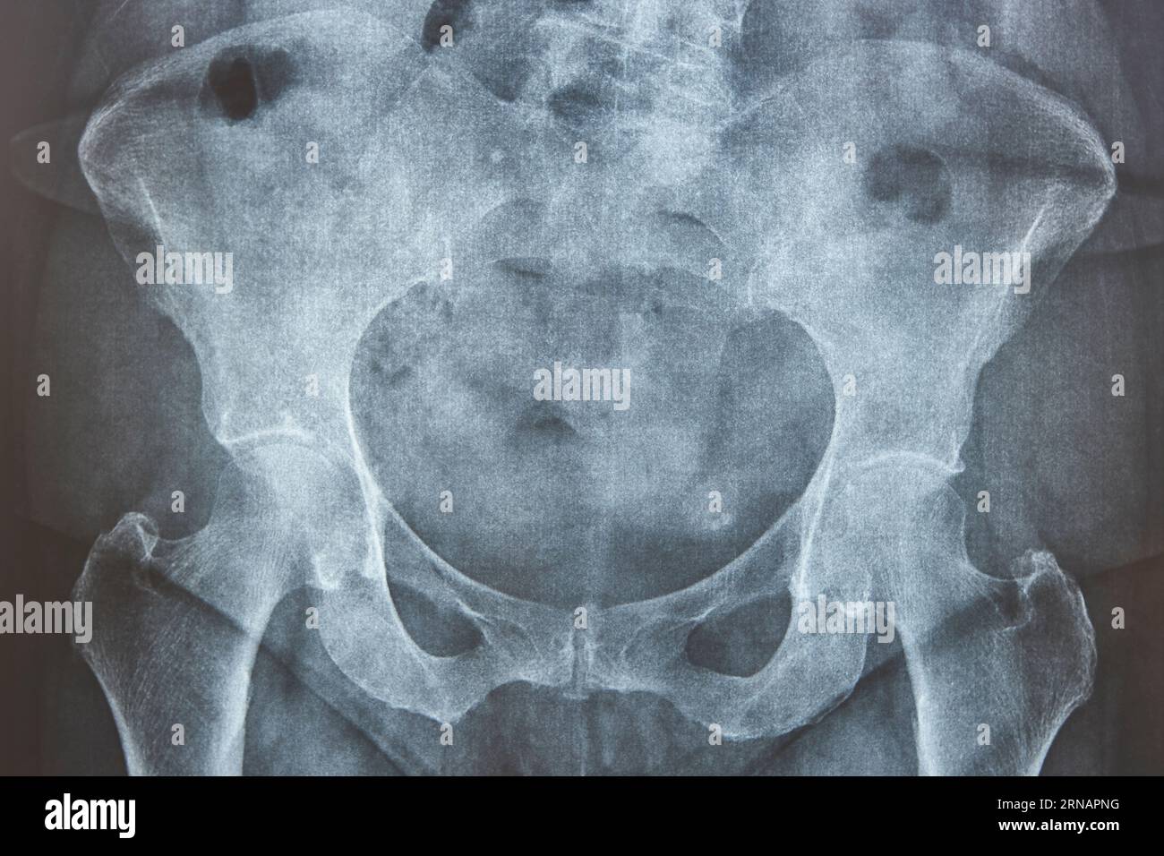 Hip xray. Scheletro umano. Pelvi e osso femorale. Anatomia Foto Stock