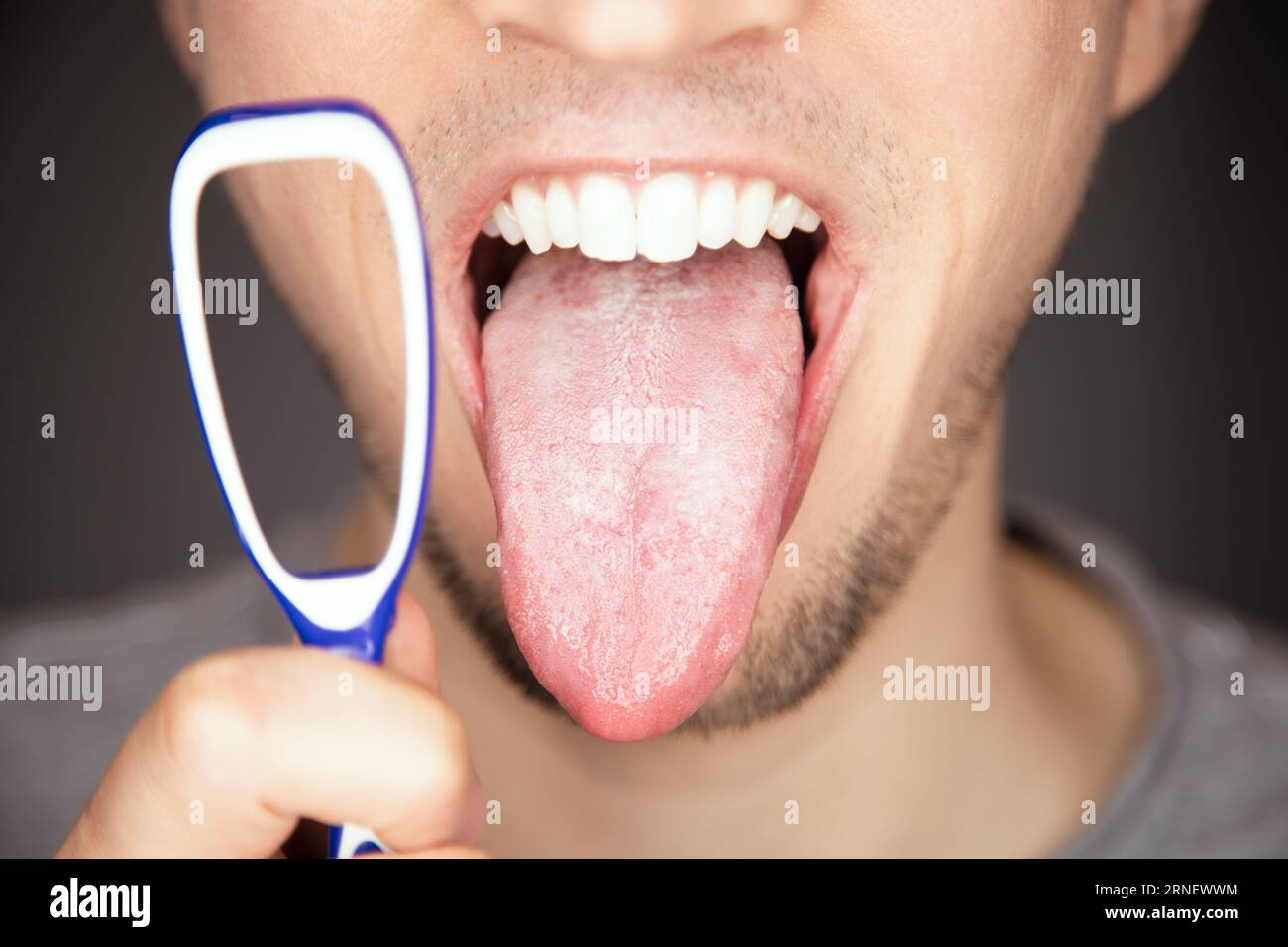 la lingua bianca ricoperta e rivestita con piccoli urti è indicatore di malattia e infezioni e motivo di alito cattivo e odore, ma può essere pulita da Foto Stock