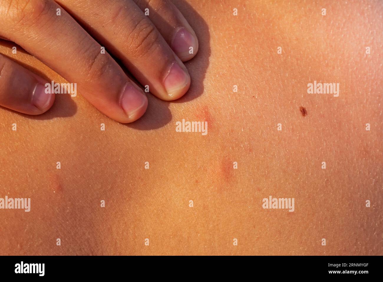 punture di insetti sulla pelle. Reazione allergica. Infiammazione cutanea. acne. Malattie e trattamento delle malattie della pelle Foto Stock