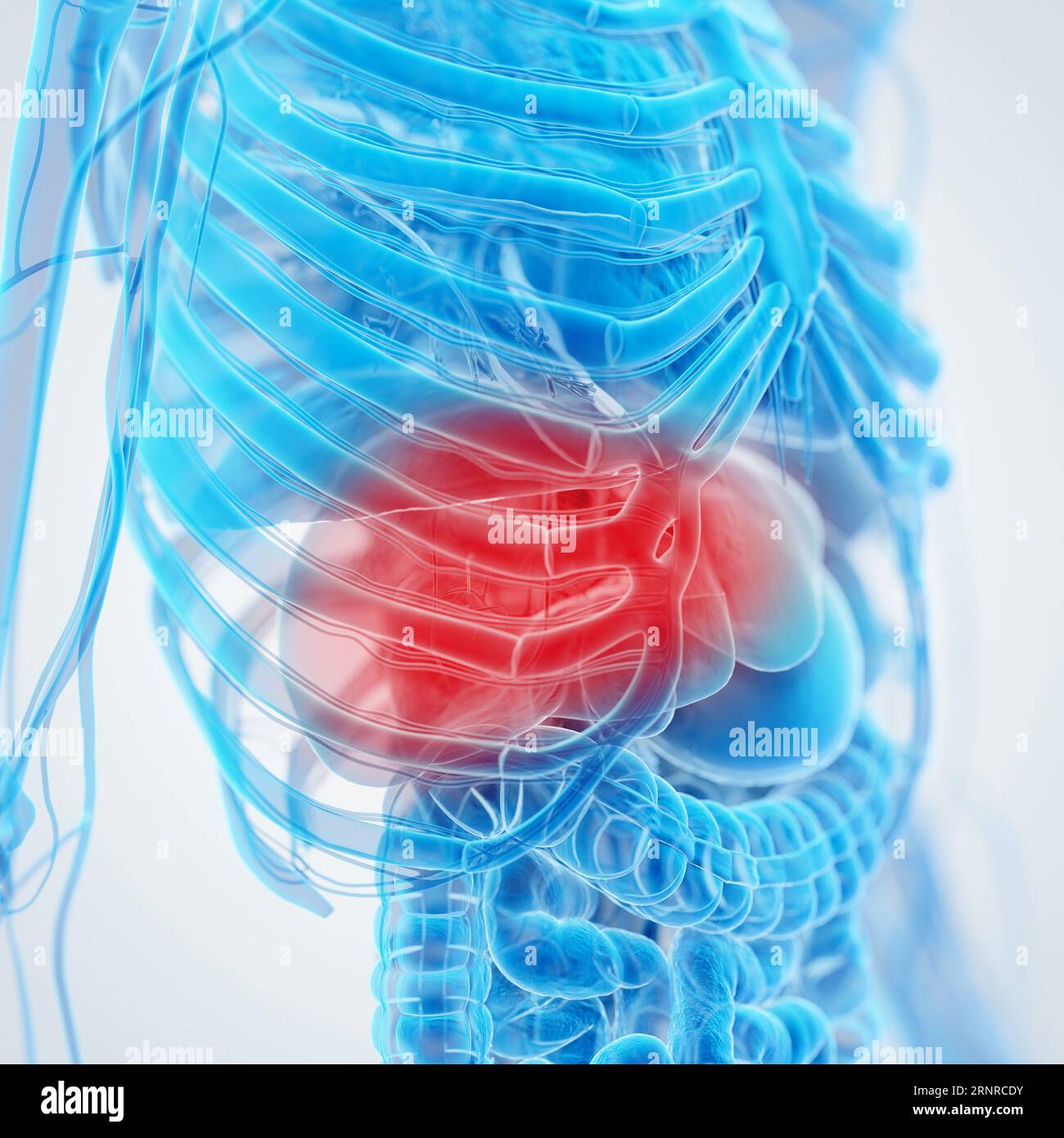Fegato infiammato, illustrazione Foto Stock