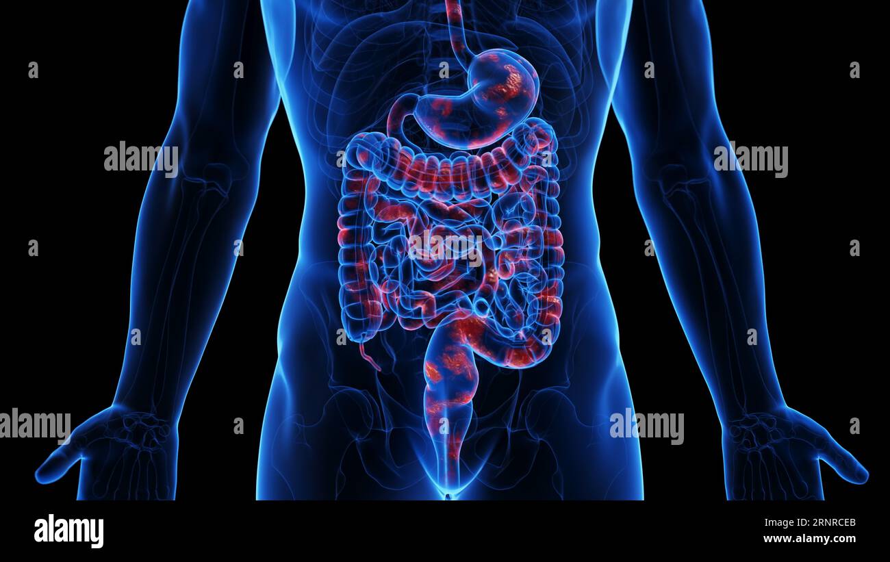Morbo di Crohn, illustrazione Foto Stock