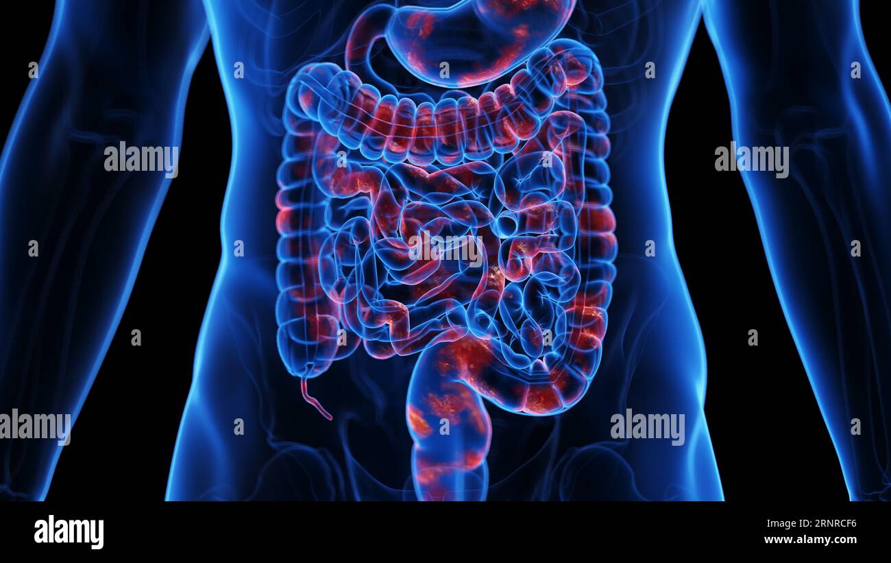 Morbo di Crohn, illustrazione Foto Stock