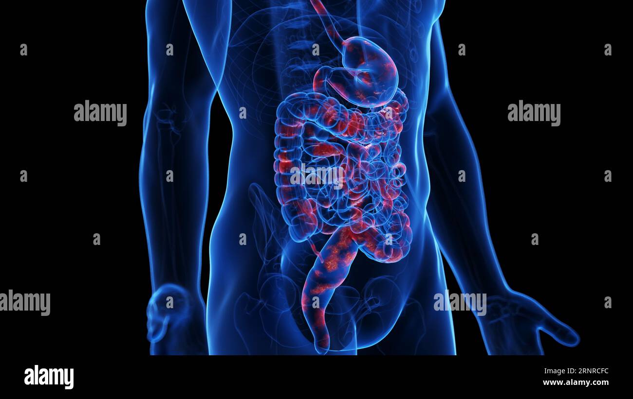 Morbo di Crohn, illustrazione Foto Stock