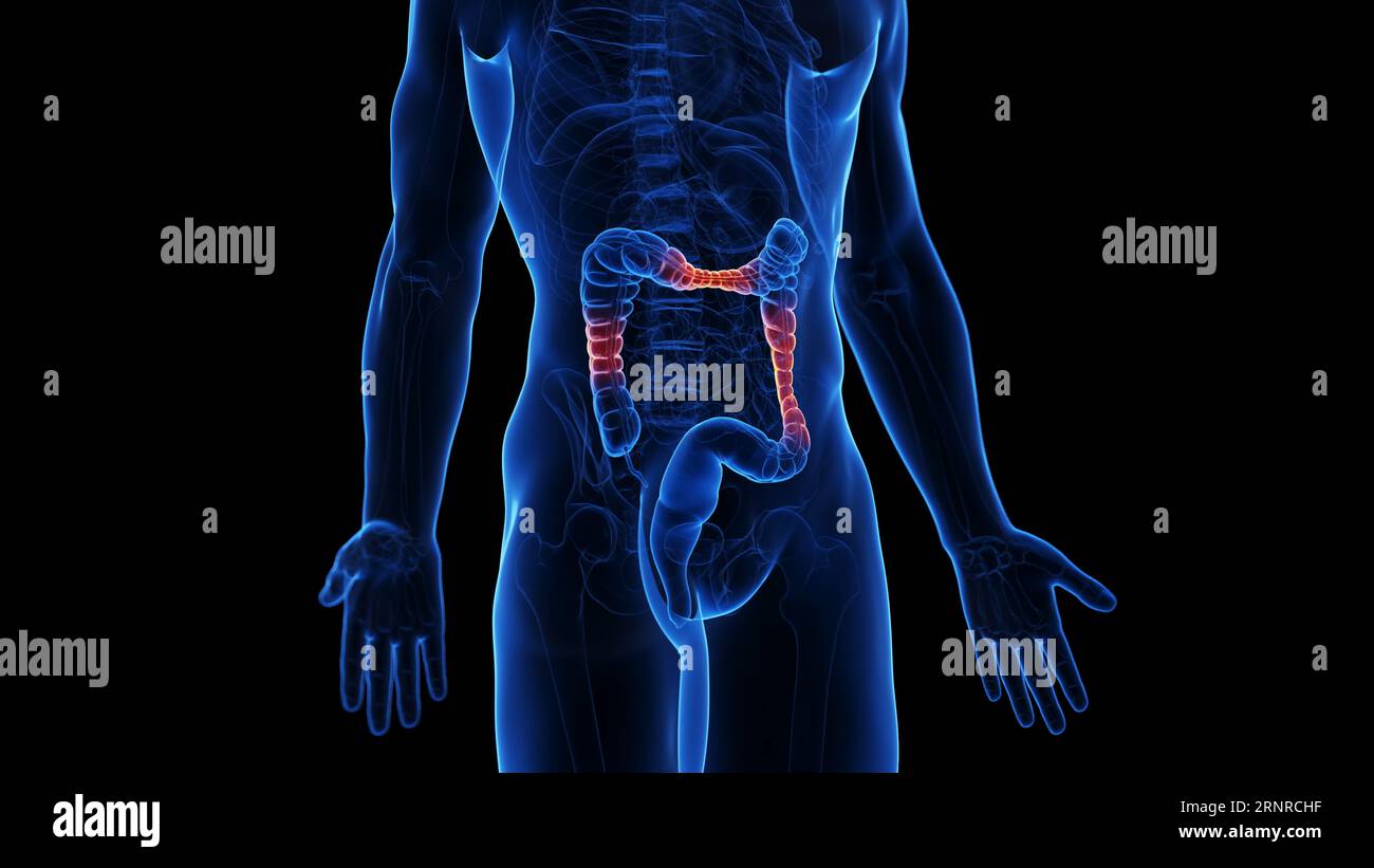 Malattia infiammatoria intestinale, illustrazione Foto Stock