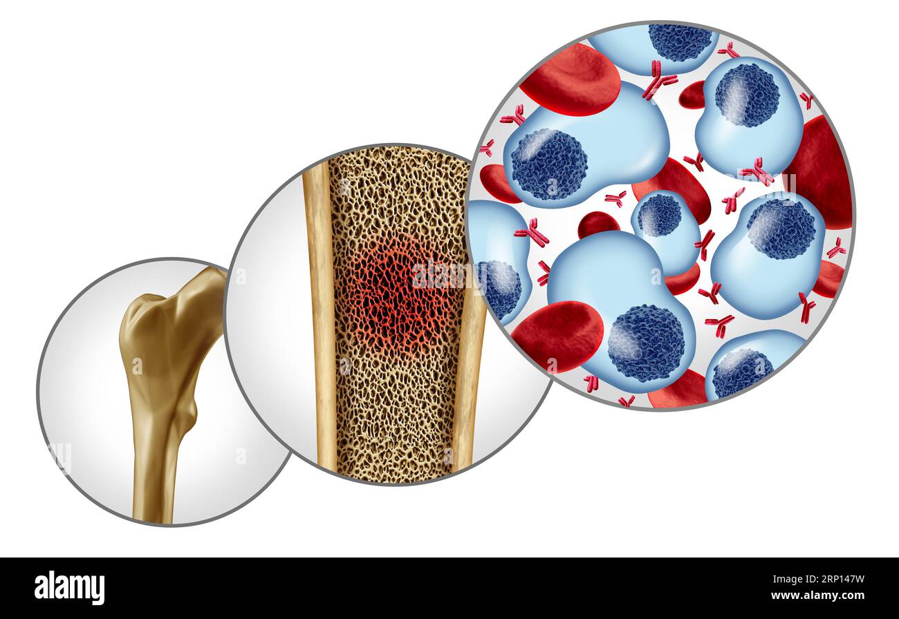 Il concetto di mieloma multiplo e il cancro delle plasmacellule come crescita cancerosa all'interno del midollo osseo Foto Stock