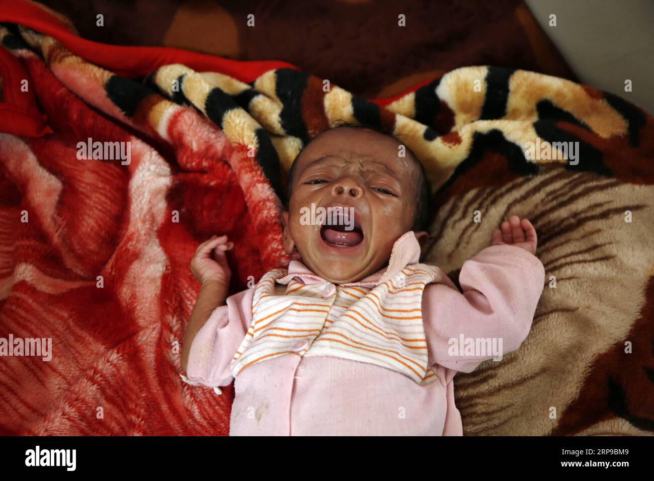 (190401) -- SANAA, 1 aprile 2019 -- Un bambino malnutrito piange in un centro di cura della malnutrizione a Sanaa, Yemen, il 1 aprile 2019. Secondo il Fondo delle Nazioni Unite per l'infanzia (UNICEF), circa 394.000 bambini yemeniti sotto i 5 anni soffrono di grave malnutrizione acuta e necessitano di cure. YEMEN-SANAA-BAMBINI-MALNUTRIZIONE MohammedxMohammed PUBLICATIONxNOTxINxCHN Foto Stock