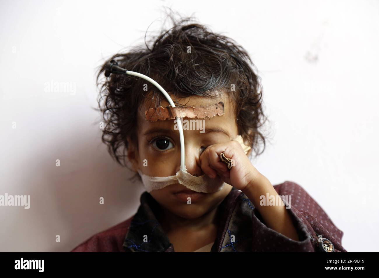 (190402) -- PECHINO, 2 aprile 2019 -- Un bambino malnutrito siede a letto mentre riceve cure mediche in un centro di cura per la malnutrizione a Sanaa, Yemen, il 1° aprile 2019. Secondo il Fondo delle Nazioni Unite per l'infanzia (UNICEF), circa 394.000 bambini yemeniti sotto i 5 anni soffrono di grave malnutrizione acuta e necessitano di cure. XINHUA FOTO DEL GIORNO MohammedxMohammed PUBLICATIONxNOTxINxCHN Foto Stock