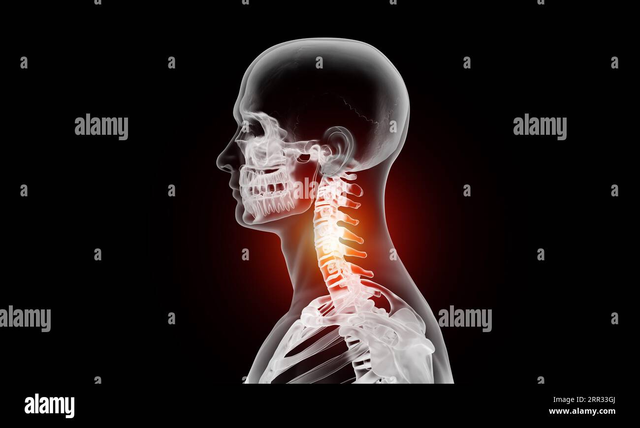 Vista laterale della sezione cervicale della lesione della colonna vertebrale e dolore su sfondo nero Foto Stock