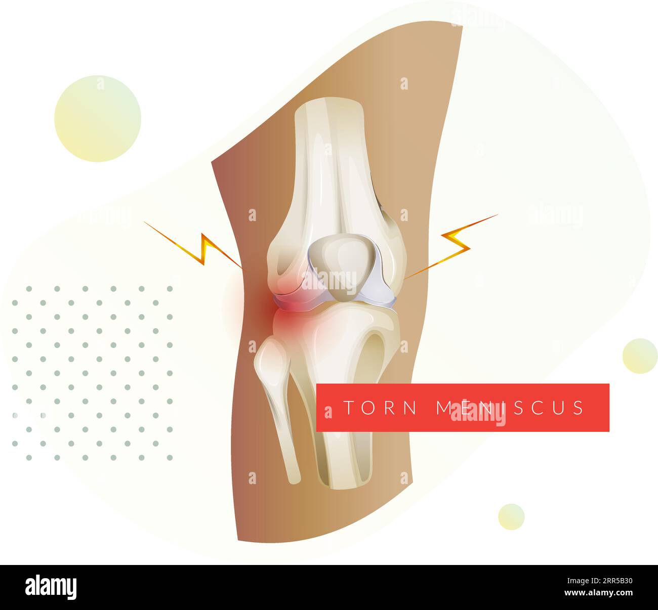 Lesione della cartilagine del ginocchio - menisco lacerato - illustrazione stock come file EPS 10 Illustrazione Vettoriale