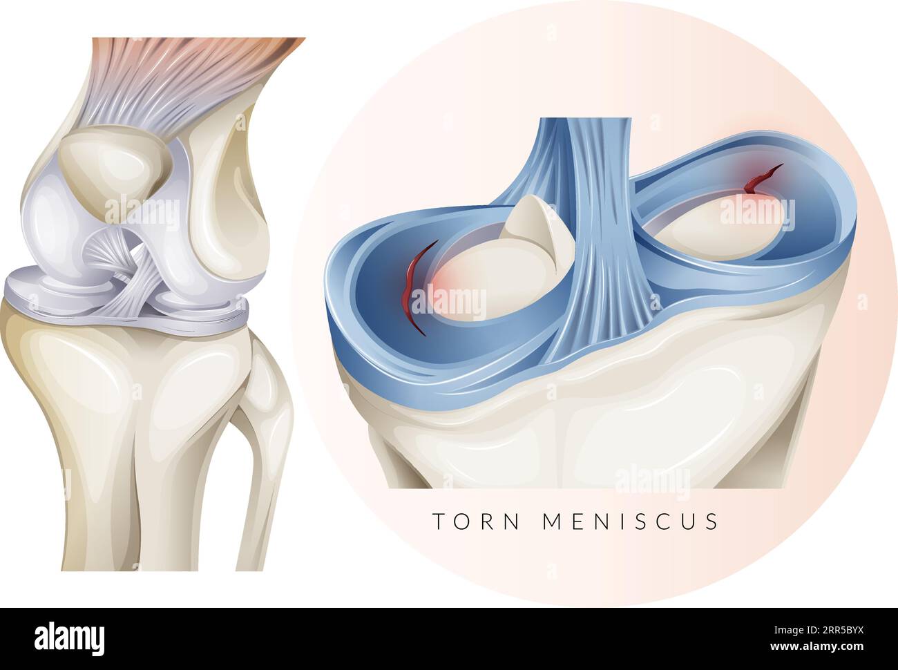 Lesione della cartilagine del ginocchio - menisco lacerato - illustrazione  stock come file EPS 10 Immagine e Vettoriale - Alamy