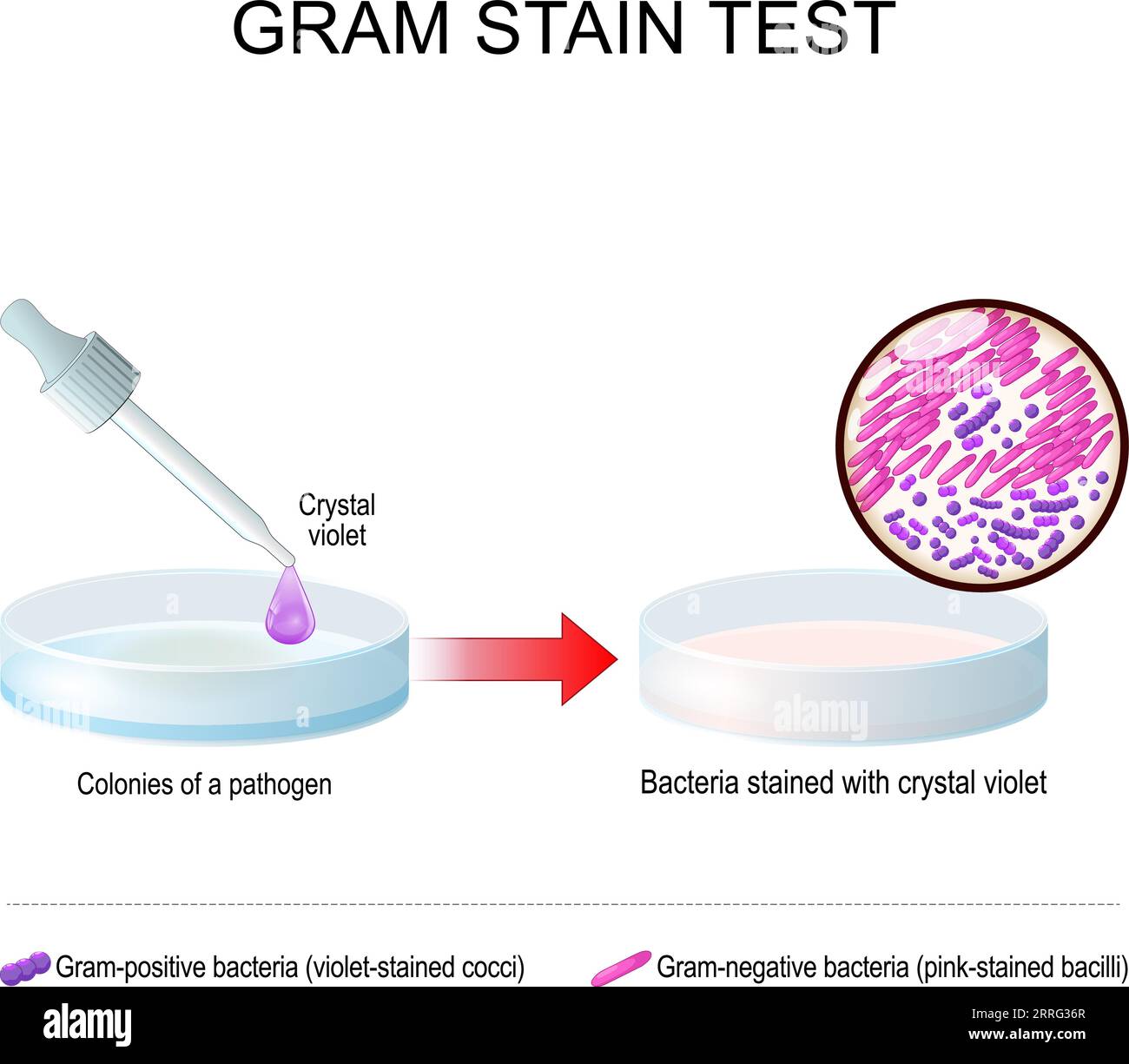 Test di colorazione Gram. Una capsula di Petri in vetro con coltura batterica patogena prima e dopo l'uso Crystal Violet. Batteri macchiati con viola genziana. Gram-po Illustrazione Vettoriale