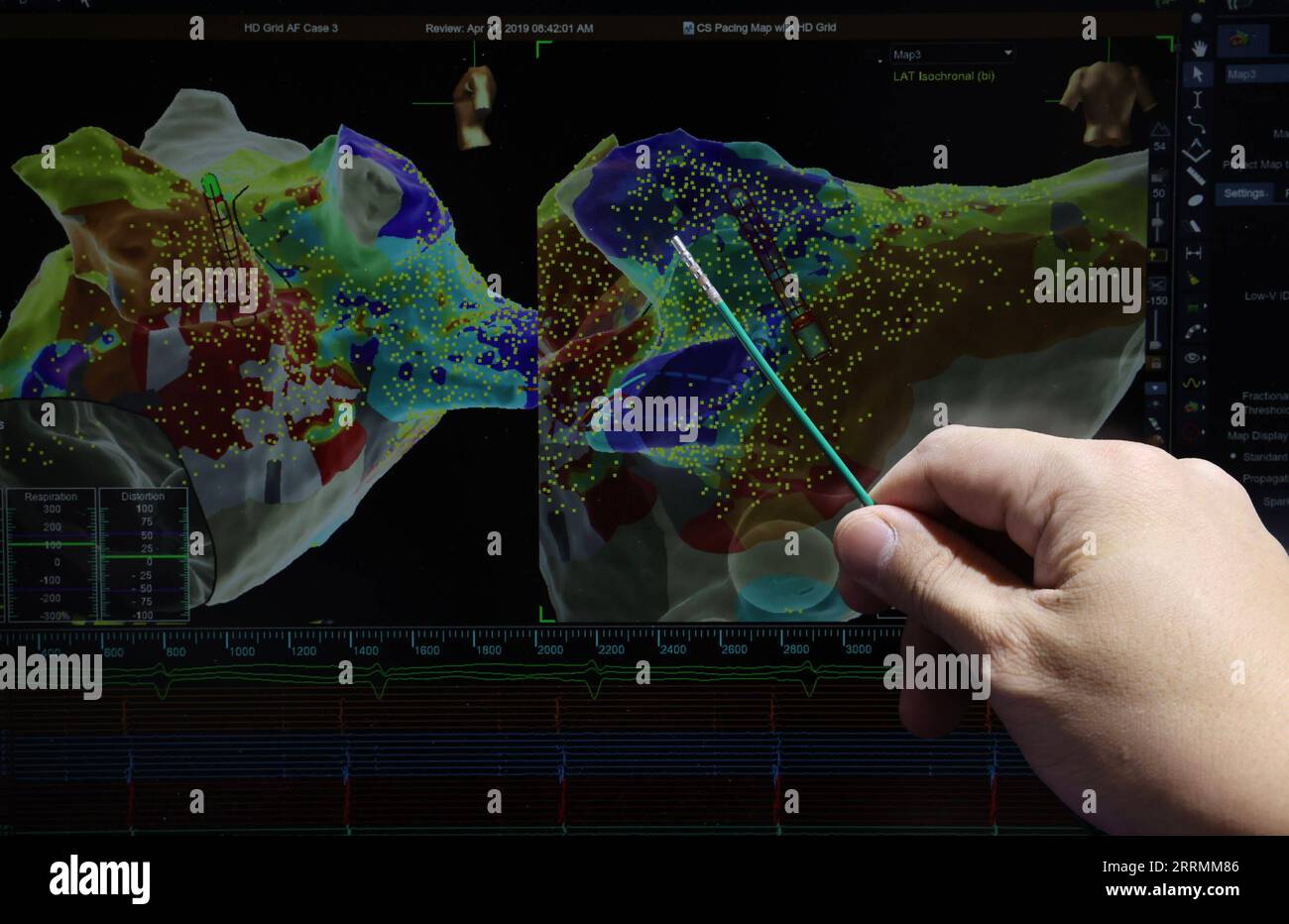 221105 -- SHANGHAI, 5 novembre 2022 -- un catetere di ablazione utilizzato per i test a ultrasuoni cardiaci è esposto presso l'area espositiva delle attrezzature mediche e dei prodotti sanitari del quinto CIIE China International Import Expo presso il National Exhibition and Convention Center di Shanghai, nella Cina orientale, a Shanghai, 5 novembre 2022. Durante l'expo, che ha avuto inizio a Shanghai sabato, vengono esposte molte mostre per la prima volta. CIIE CHINA-SHANGHAI-CIIE-EXHIBITION CN JINXLIWANG PUBLICATIONXNOTXINXCHN Foto Stock