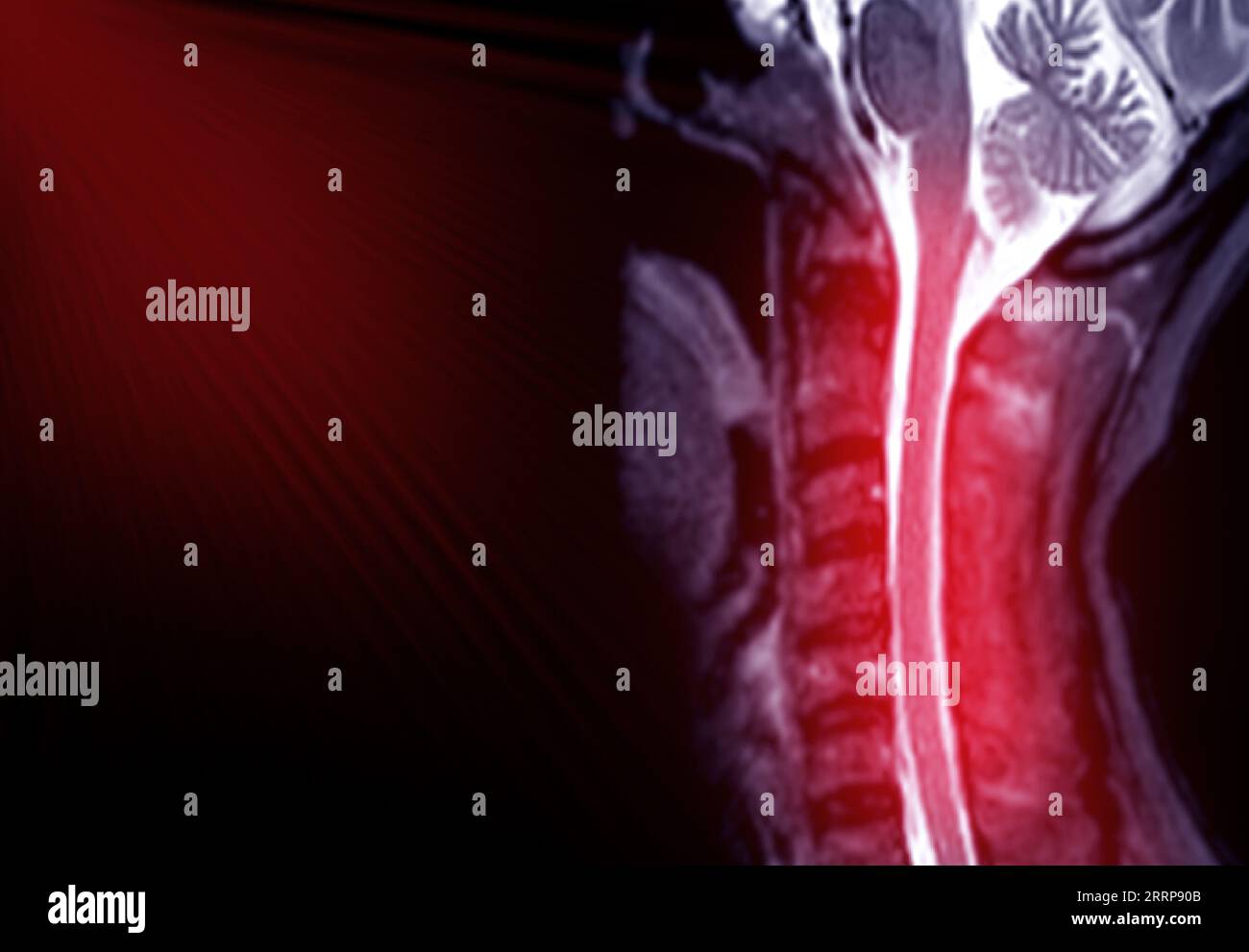 Risonanza magnetica della colonna cervicale o immagine di risonanza magnetica della vista sagittale della colonna cervicale per la diagnosi di spondilosi che causa mielopatia spondilotica cervicale e com Foto Stock