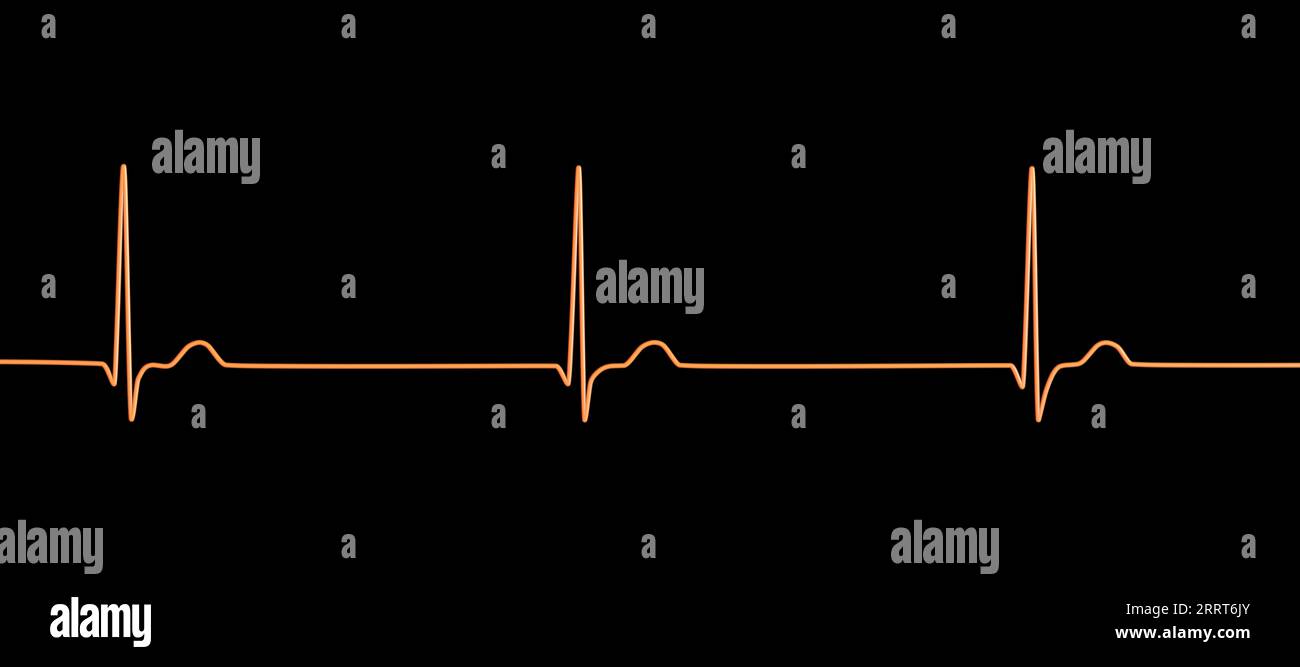 Ritmo giunzionale del battito cardiaco, illustrazione Foto Stock