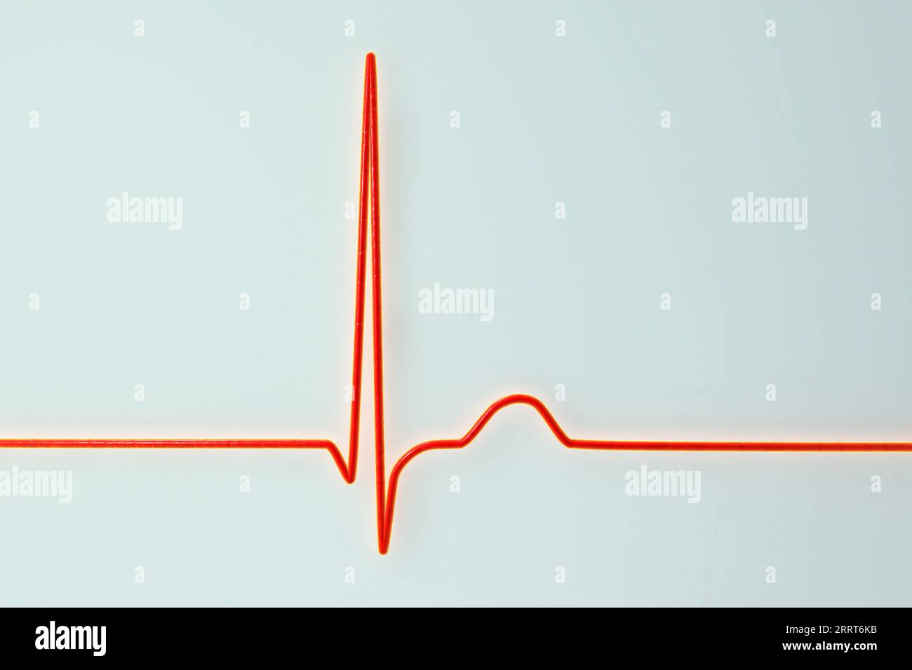 Ritmo giunzionale del battito cardiaco, illustrazione Foto Stock