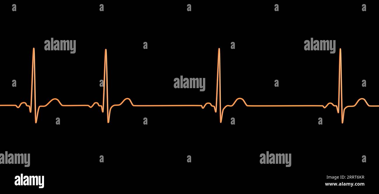 Aritmia sinusale ritmo cardiaco, illustrazione Foto Stock