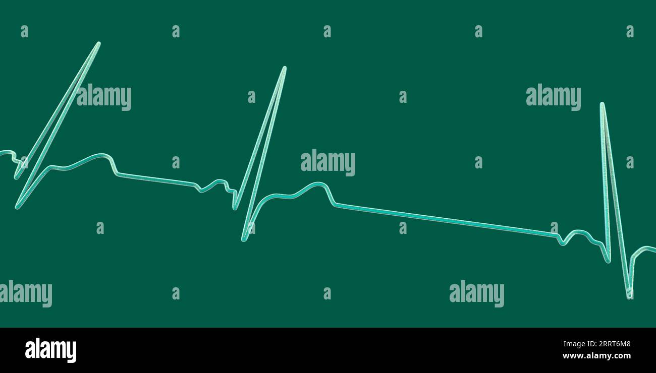 Aritmia sinusale ritmo cardiaco, illustrazione Foto Stock