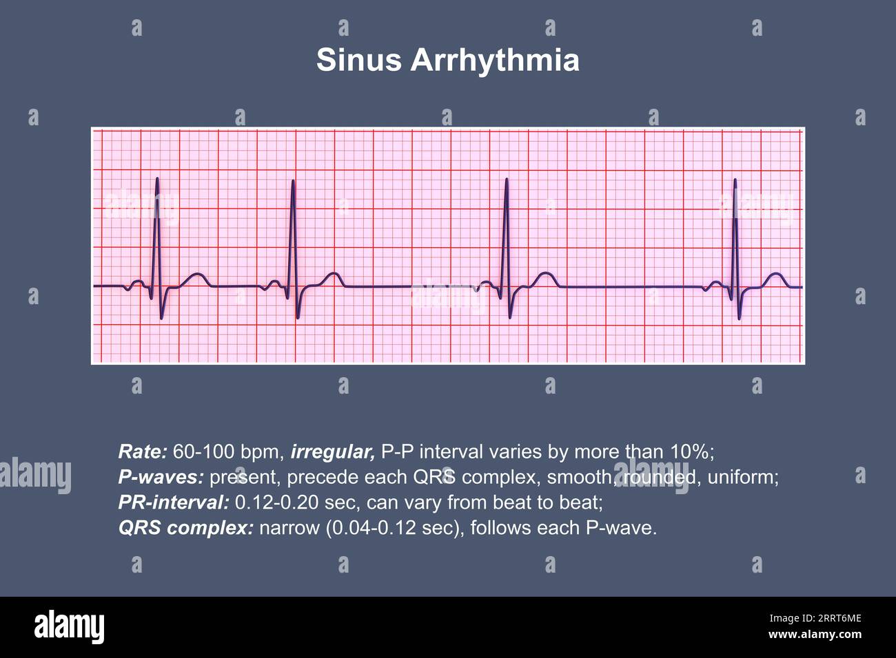 Aritmia sinusale ritmo cardiaco, illustrazione Foto Stock