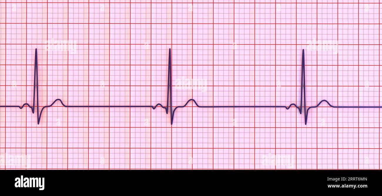 Bradicardia sinusale ritmo cardiaco, illustrazione Foto Stock