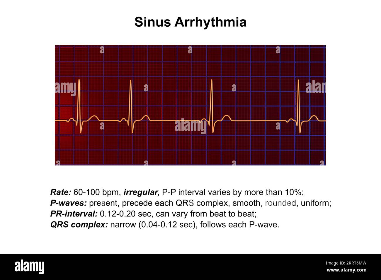 Aritmia sinusale ritmo cardiaco, illustrazione Foto Stock