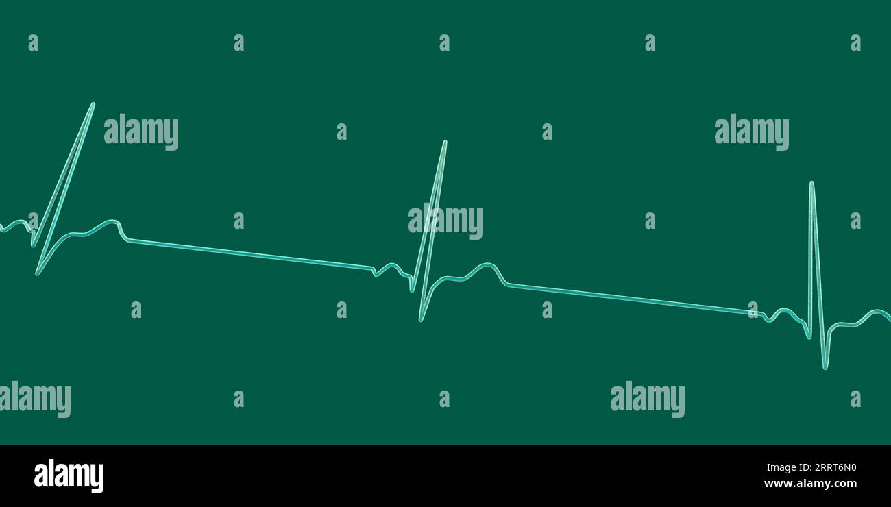Bradicardia sinusale ritmo cardiaco, illustrazione Foto Stock