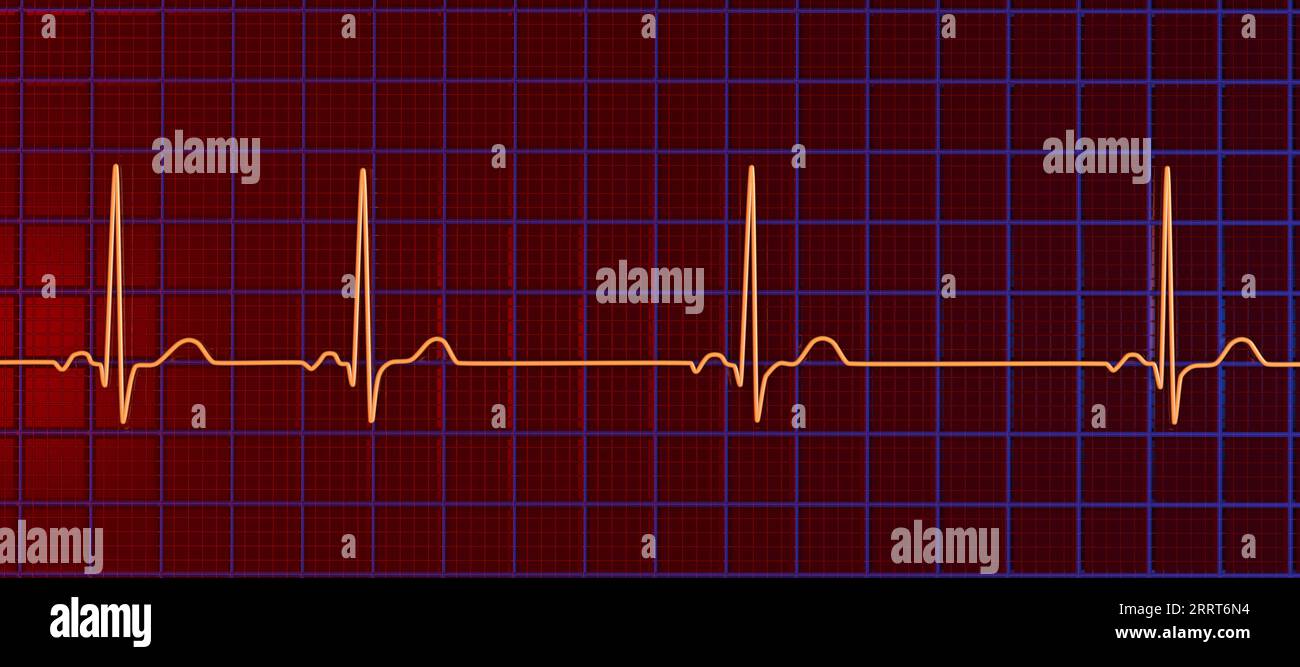 Aritmia sinusale ritmo cardiaco, illustrazione Foto Stock