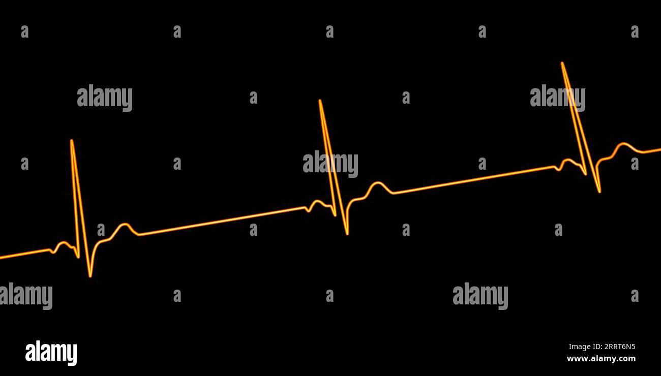 Bradicardia sinusale ritmo cardiaco, illustrazione Foto Stock
