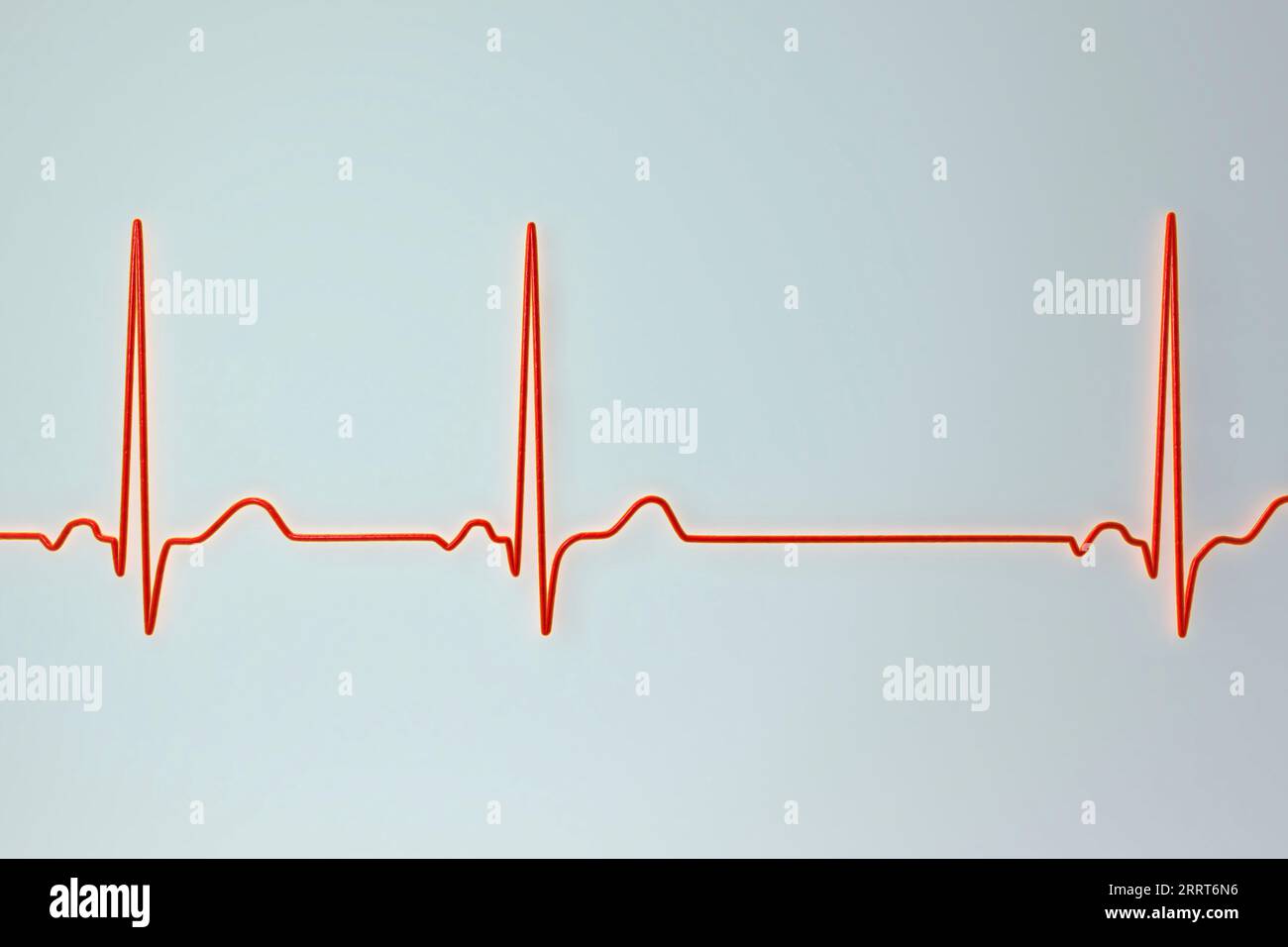 Aritmia sinusale ritmo cardiaco, illustrazione Foto Stock