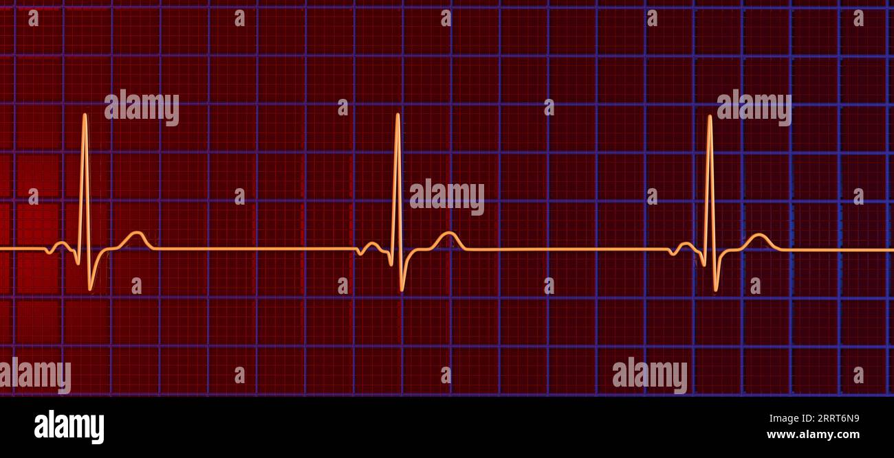 Bradicardia sinusale ritmo cardiaco, illustrazione Foto Stock