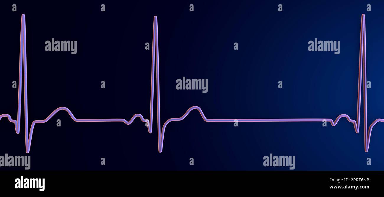 Aritmia sinusale ritmo cardiaco, illustrazione Foto Stock