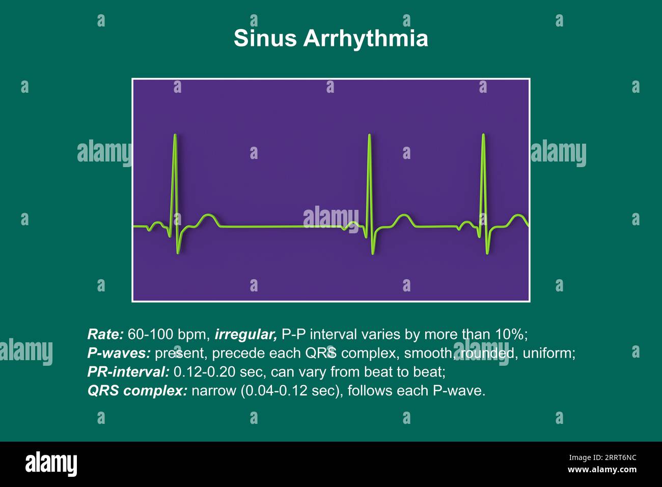 Aritmia sinusale ritmo cardiaco, illustrazione Foto Stock