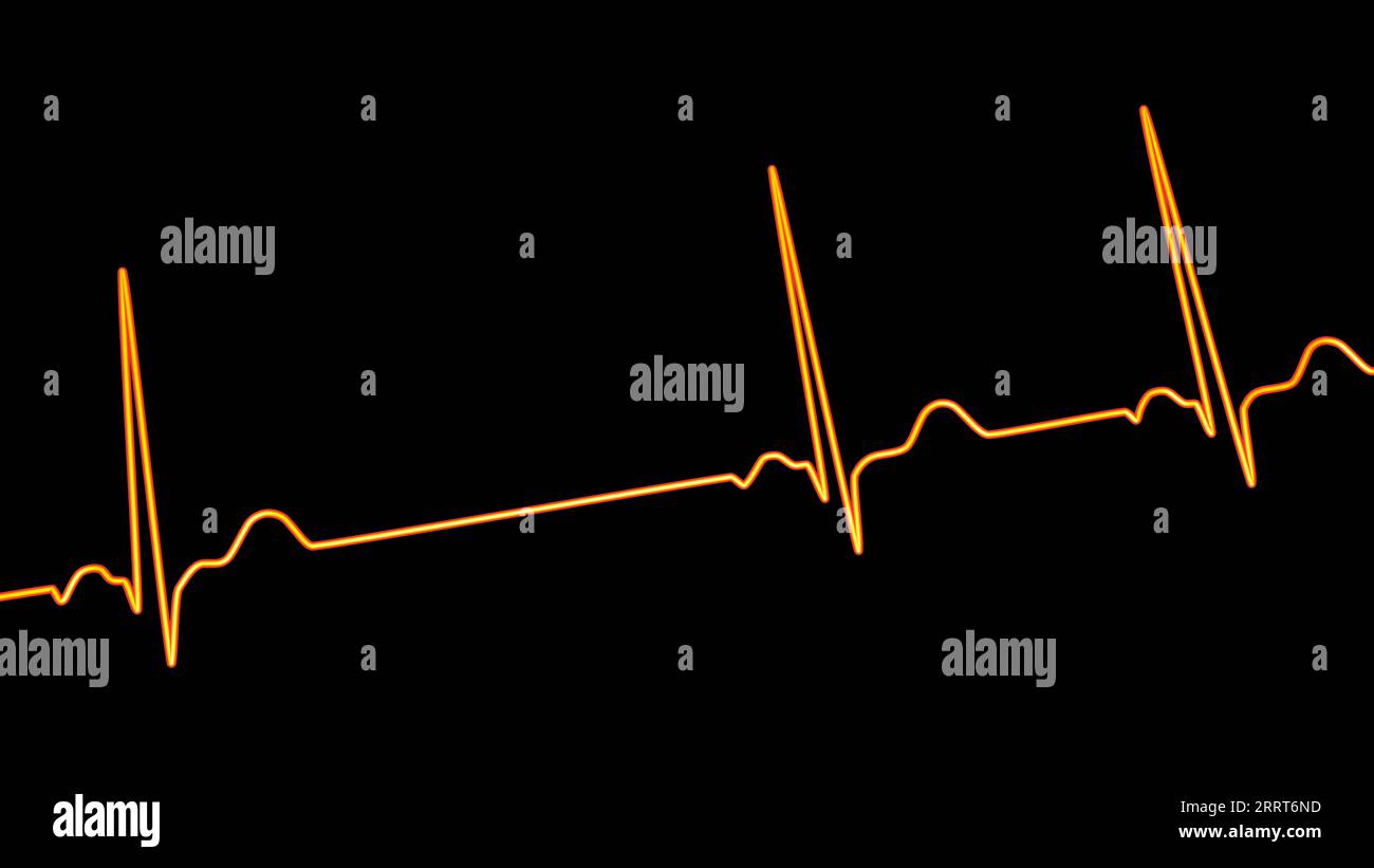 Aritmia sinusale ritmo cardiaco, illustrazione Foto Stock