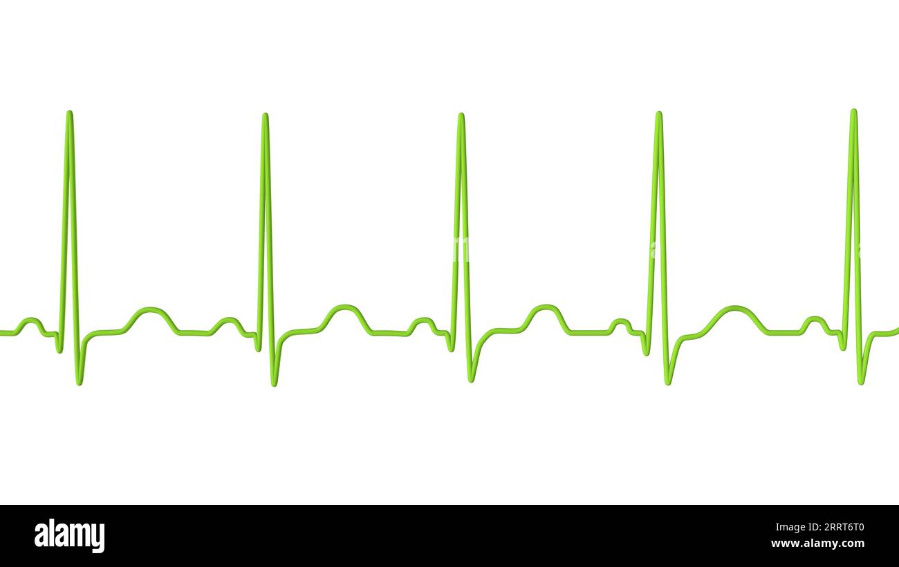 Tachicardia sinusale ritmo cardiaco, illustrazione Foto Stock
