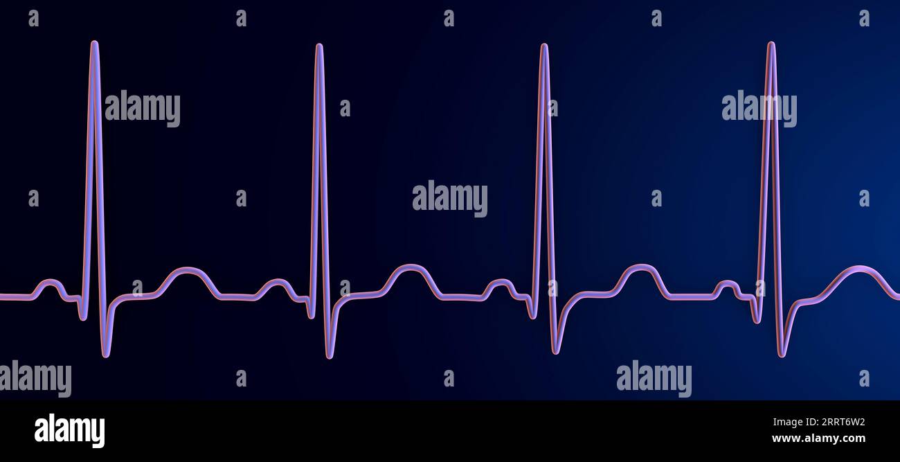 Tachicardia sinusale ritmo cardiaco, illustrazione Foto Stock