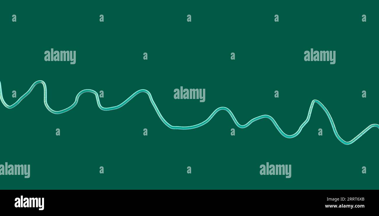 Fibrillazione ventricolare ritmo cardiaco, illustrazione Foto Stock