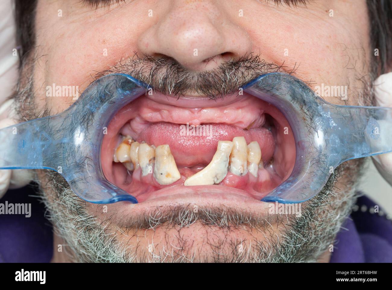 Denti rotti durante l'ispezione con divaricatore per la progettazione di impianti dentali. Foto Stock