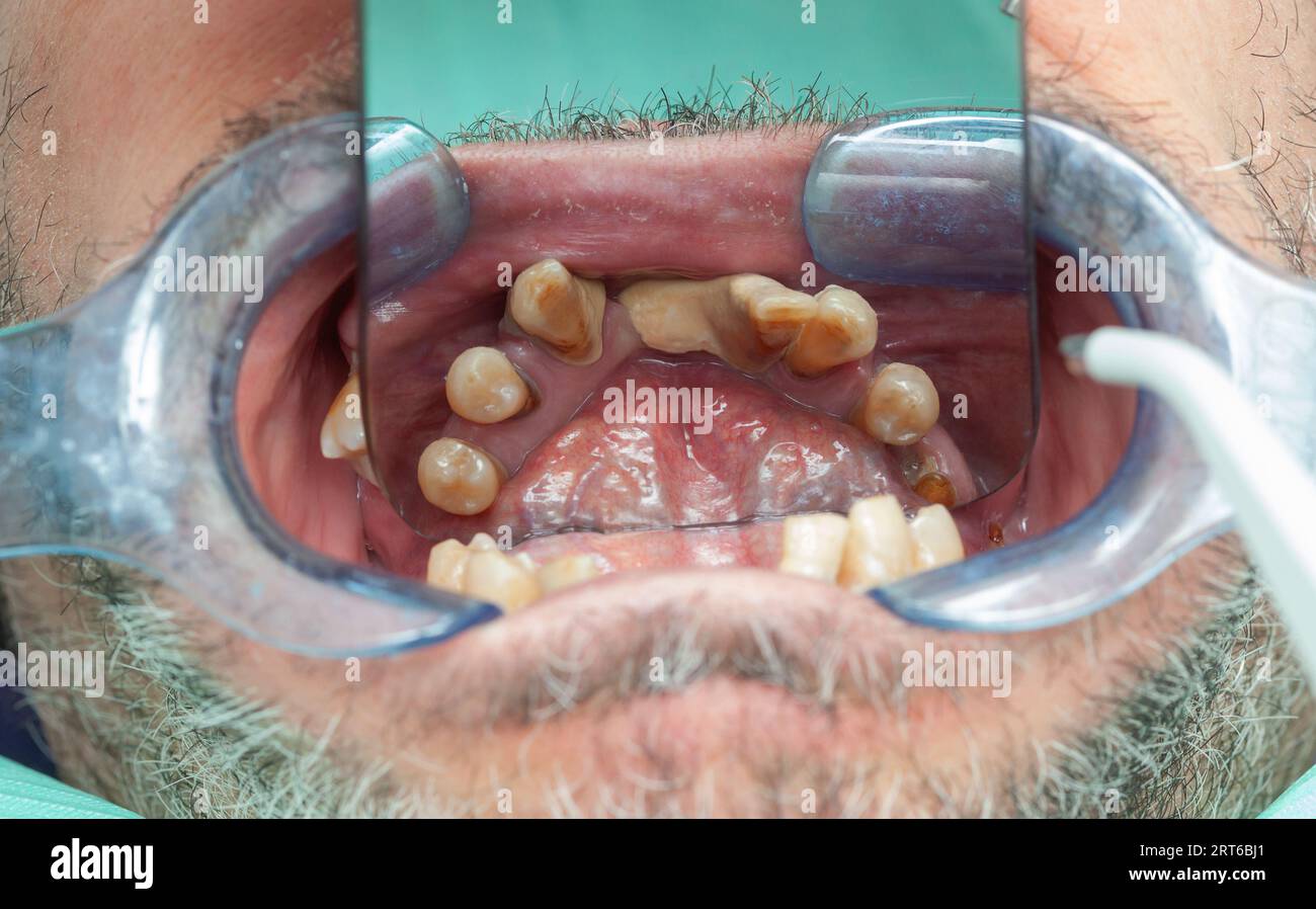 Denti rotti durante l'ispezione con divaricatore per la progettazione di impianti dentali. Foto Stock