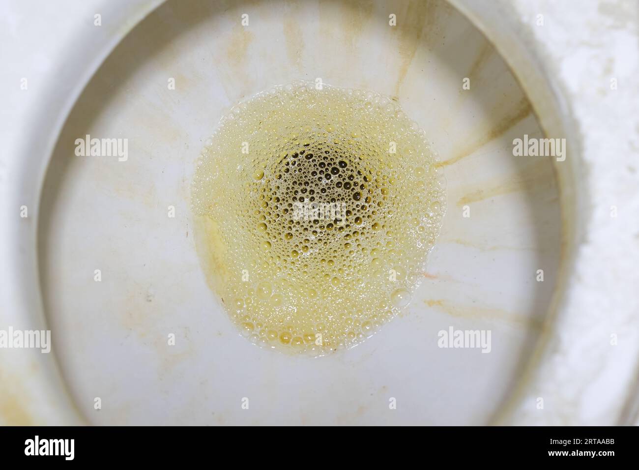 Primo piano dell'urina schiumosa nel bagno. L'urina schiumosa può essere un segno di malattia renale. Fotografia che può essere utilizzata per scopi medici. Foto Stock