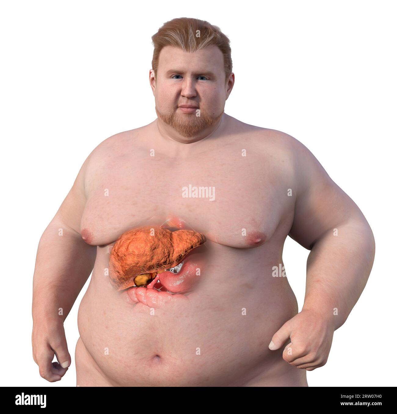 Uomo in sovrappeso con steatosi epatica, illustrazione Foto Stock