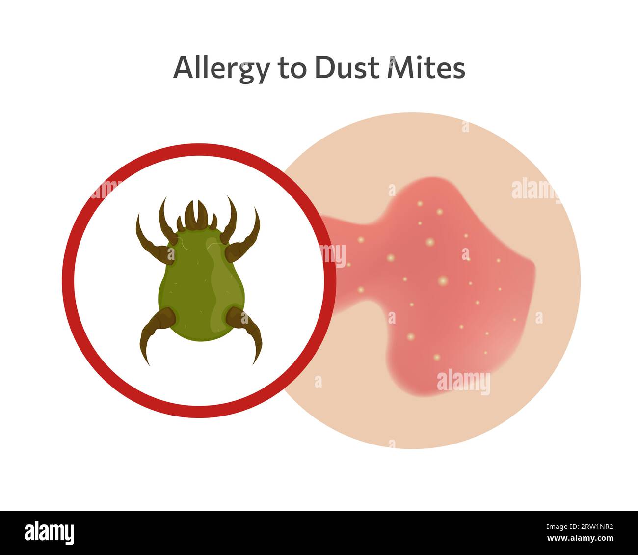 Allergia cutanea agli acari della polvere disegno illustrativo vettoriale Illustrazione Vettoriale