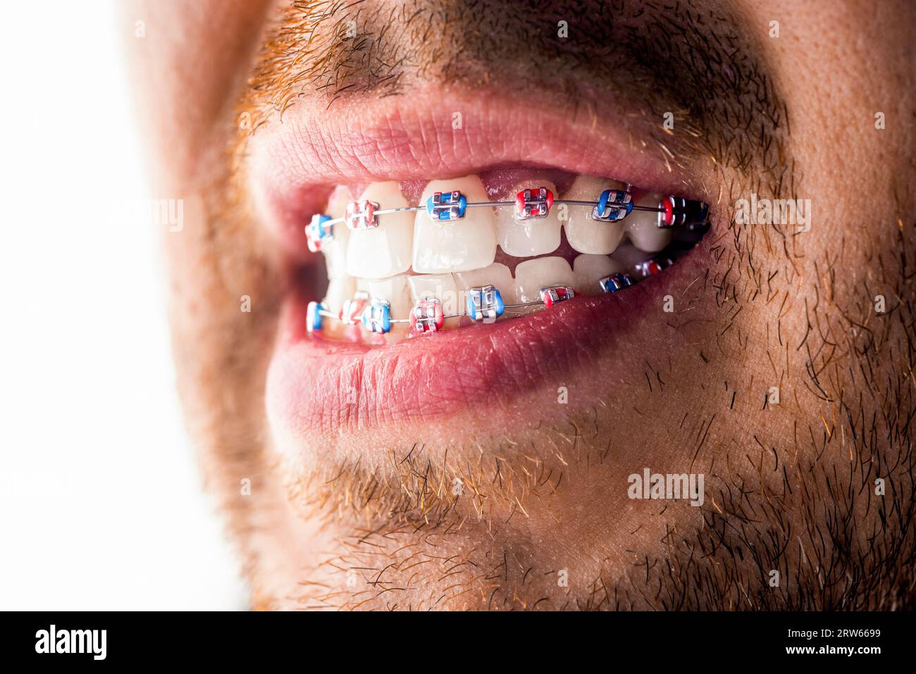 L'uomo è d'accordo. I denti si appoggiano sui denti bianchi dell'uomo per equalizzare i denti. Sistema a staffa con bocca sorridente, denti fotografici macro, labbra ravvicinate, macro Foto Stock